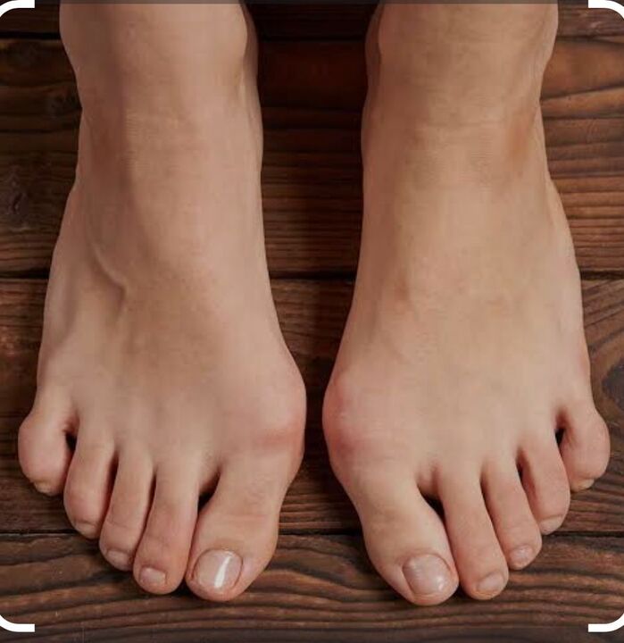 Toe Bunion